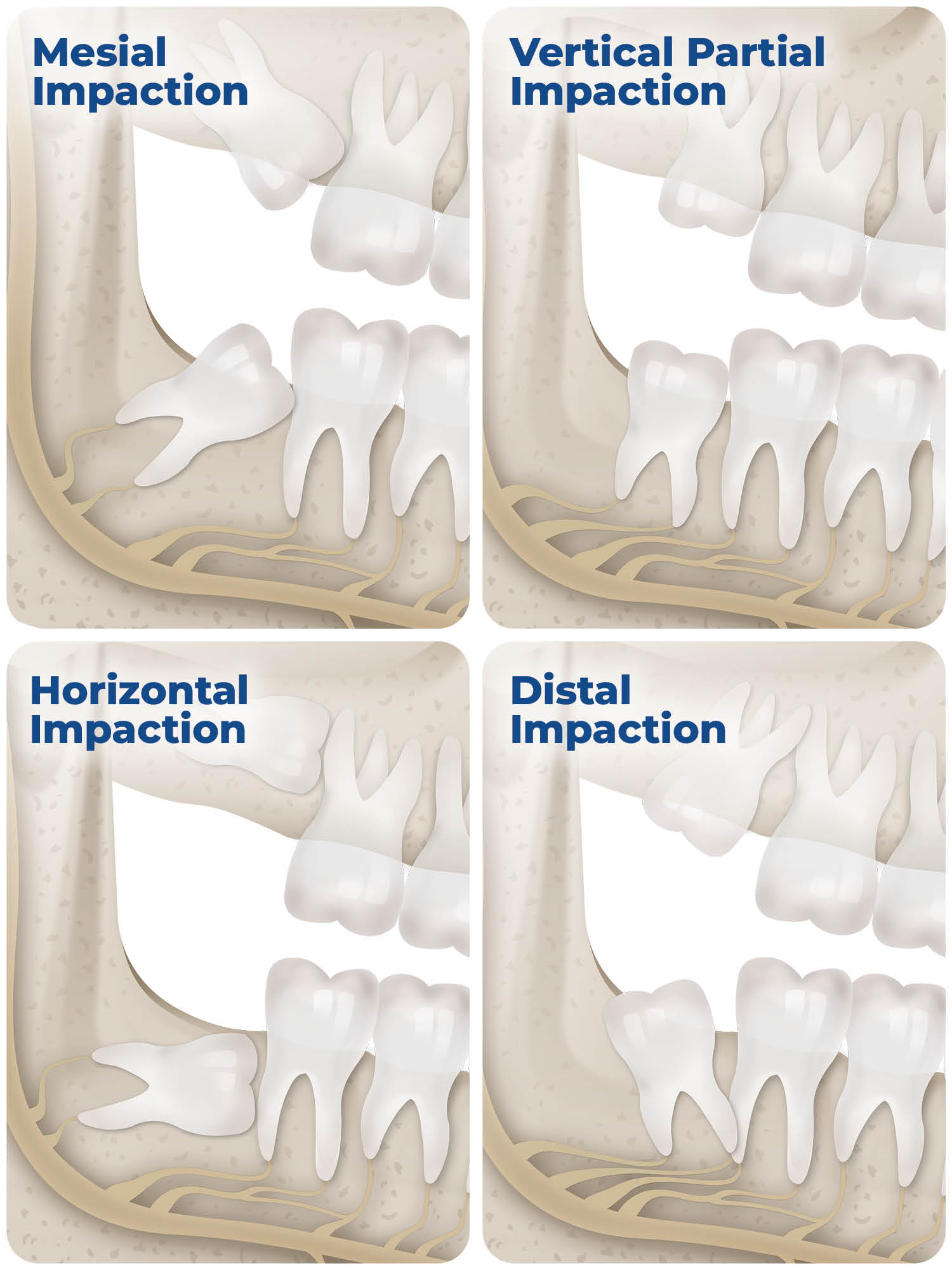 infographic showing the different types of wisdom teeth impaction