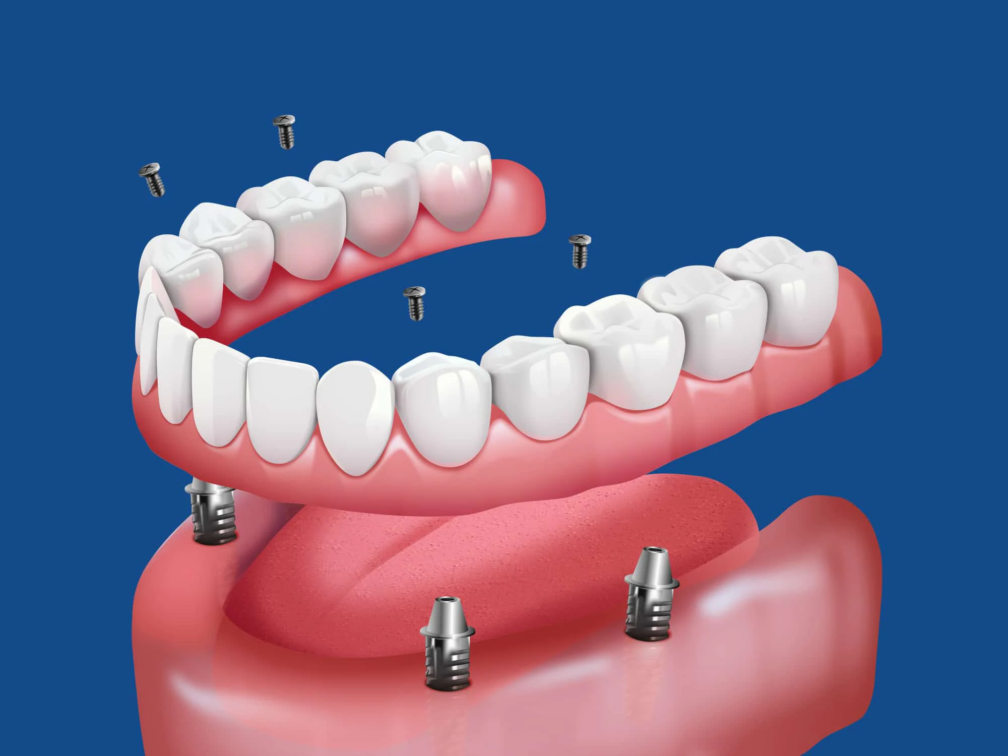 Dental illustration showing upper and lower jaw teeth with dental implants and screws, set against a blue background. No landmarks present.