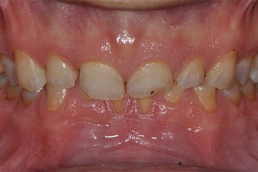Close-up image of misaligned teeth with visible gum tissue. The teeth show significant crowding and some discoloration. There are no landmarks or buildings.