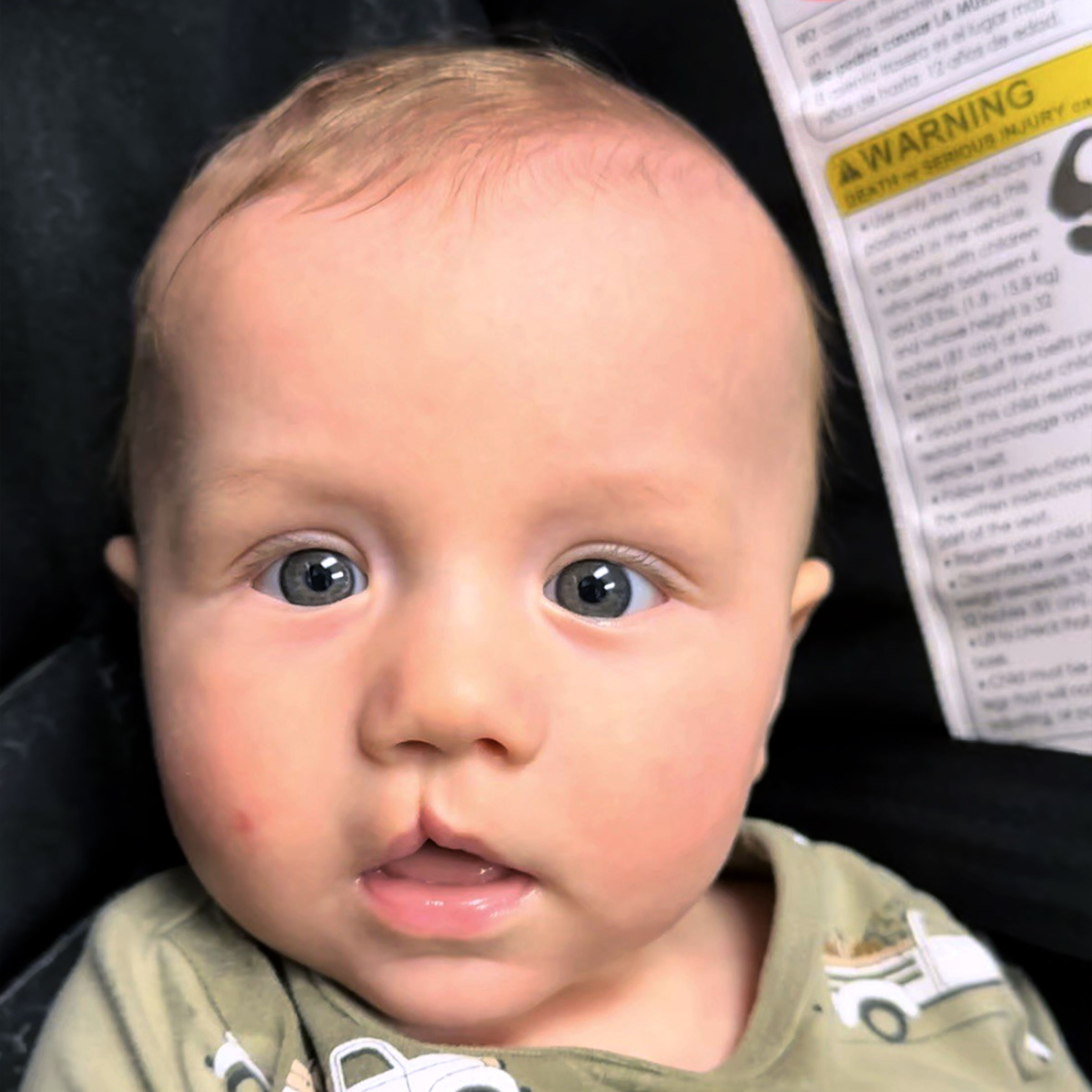 Cleft & Craniofacial Patient Transformation - Before