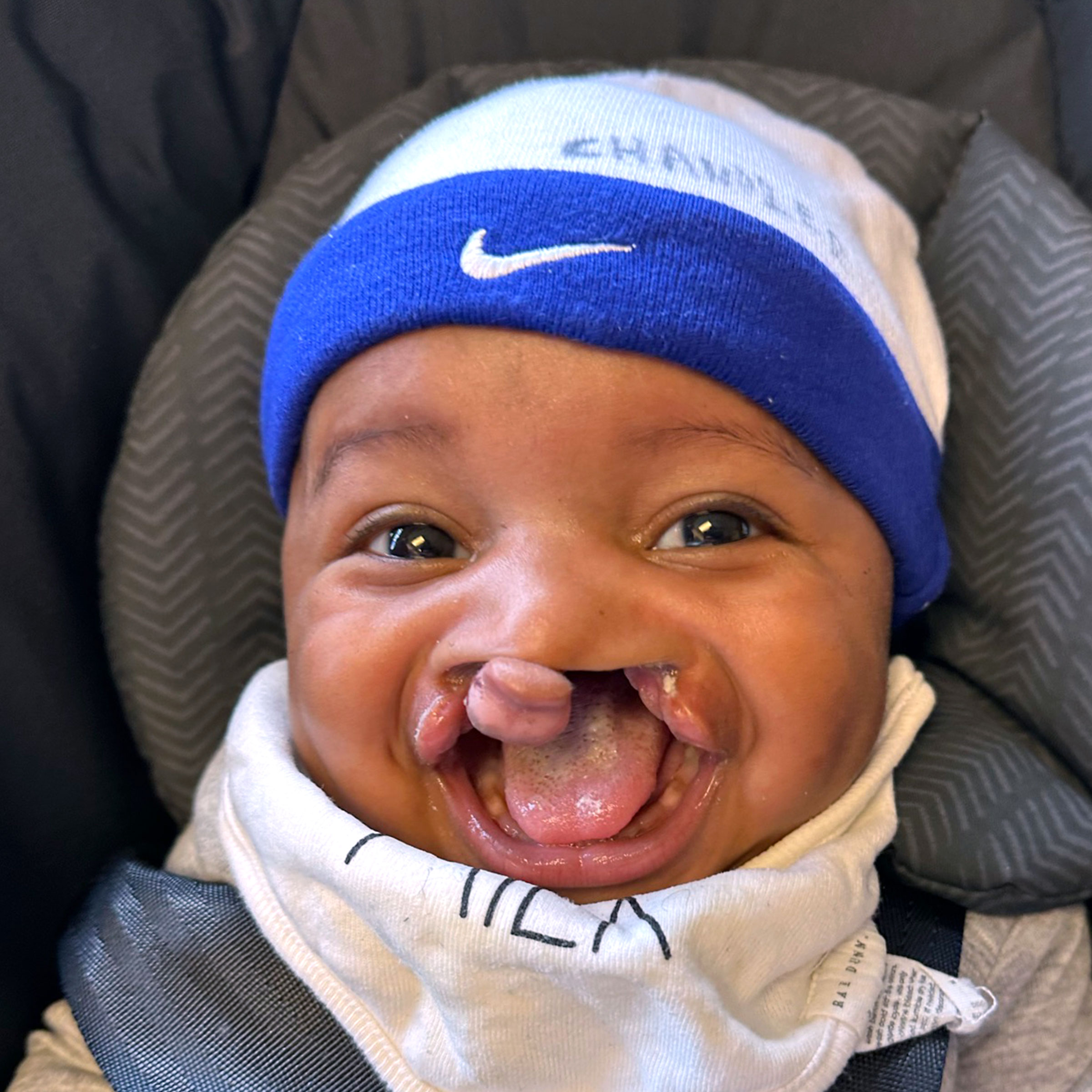 Cleft & Craniofacial Patient Transformation - Before