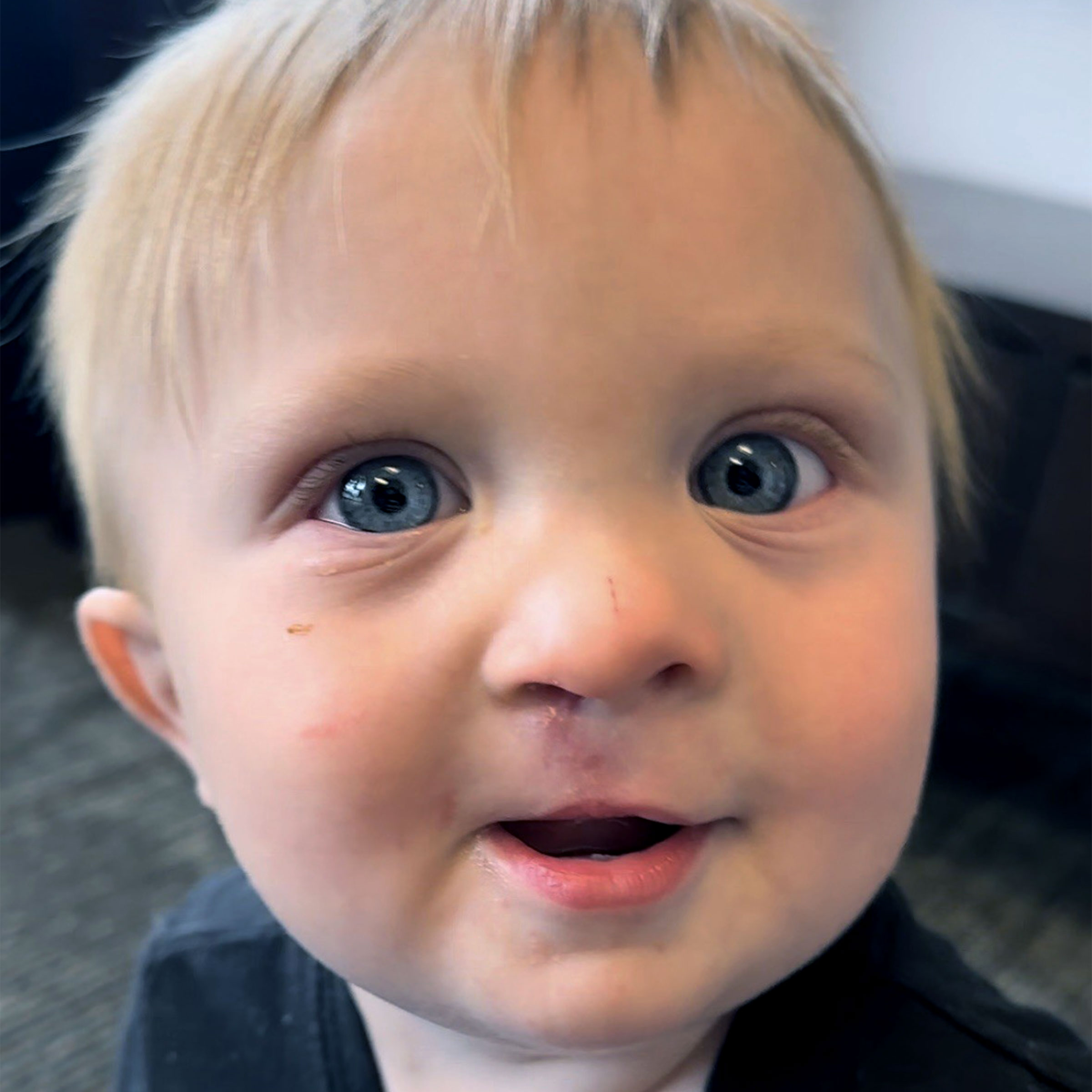 Cleft & Craniofacial Patient Transformation - After