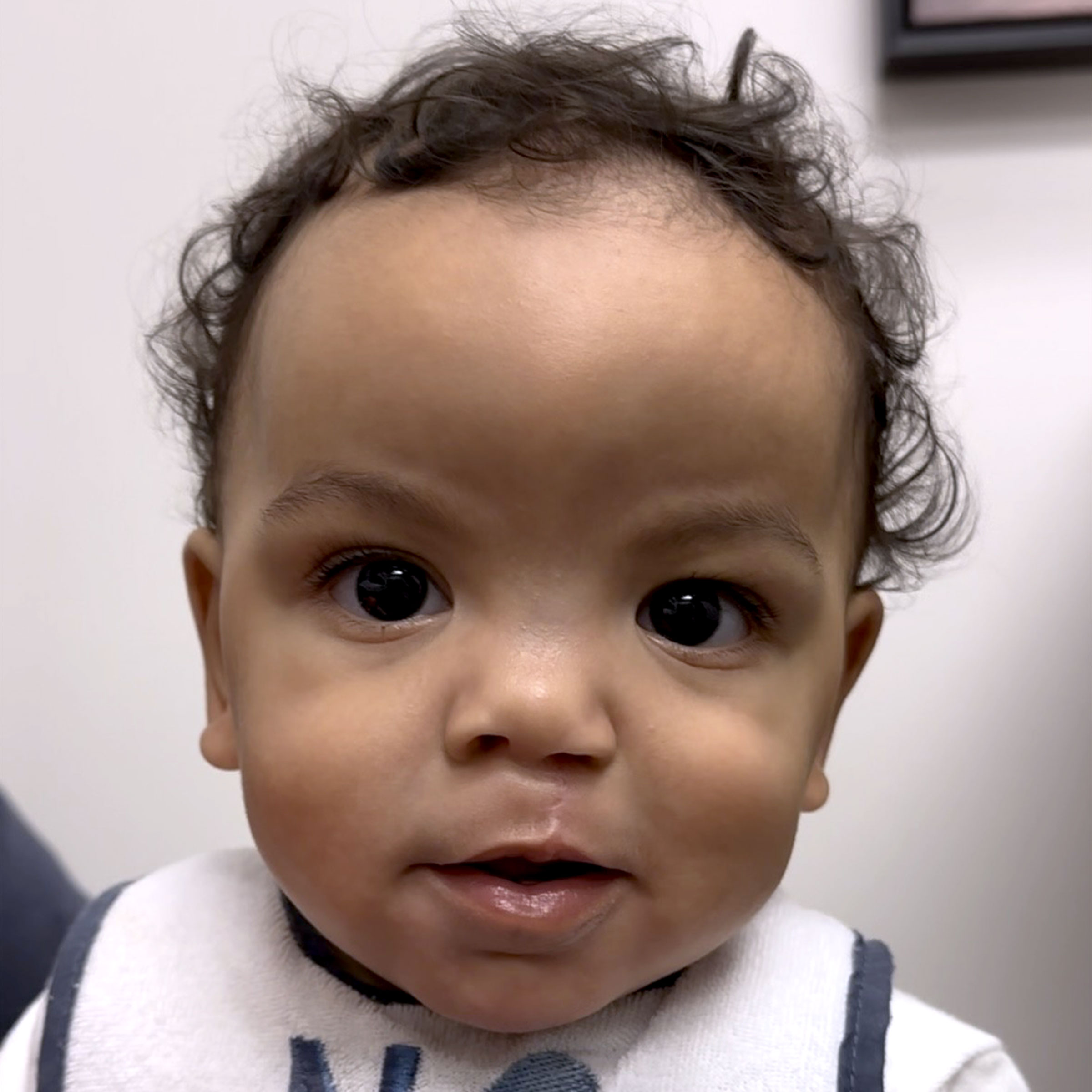 Cleft & Craniofacial Patient Transformation - After