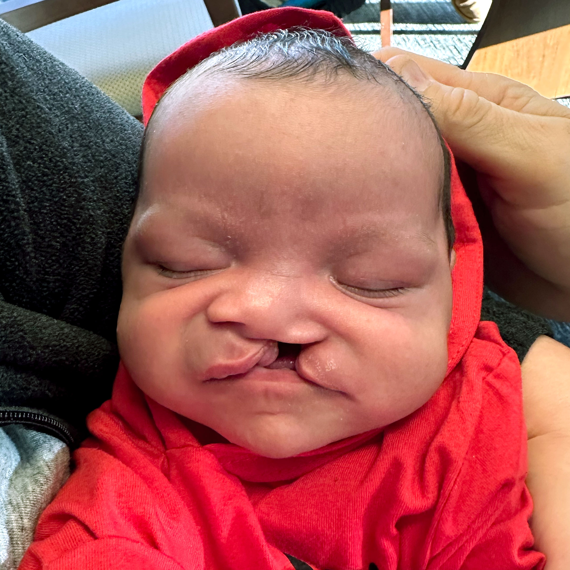 Cleft & Craniofacial Patient Transformation - Before
