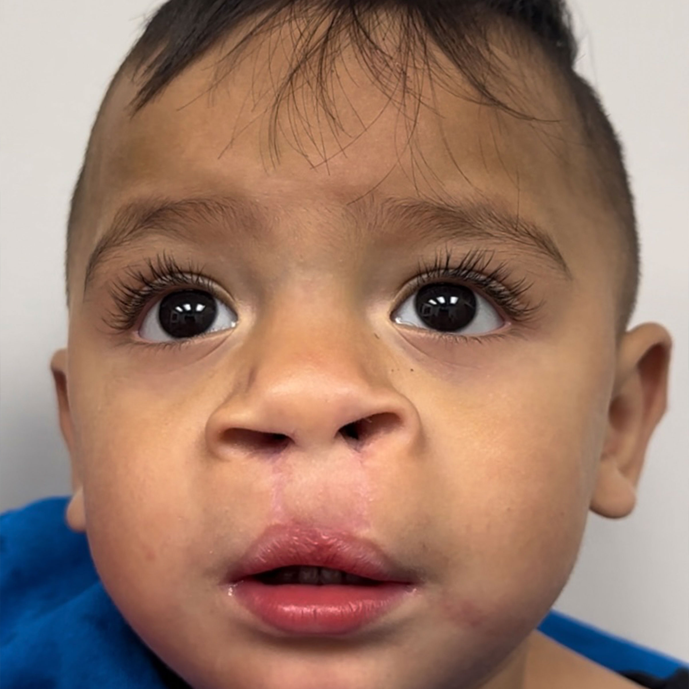 Cleft & Craniofacial Patient Transformation - After