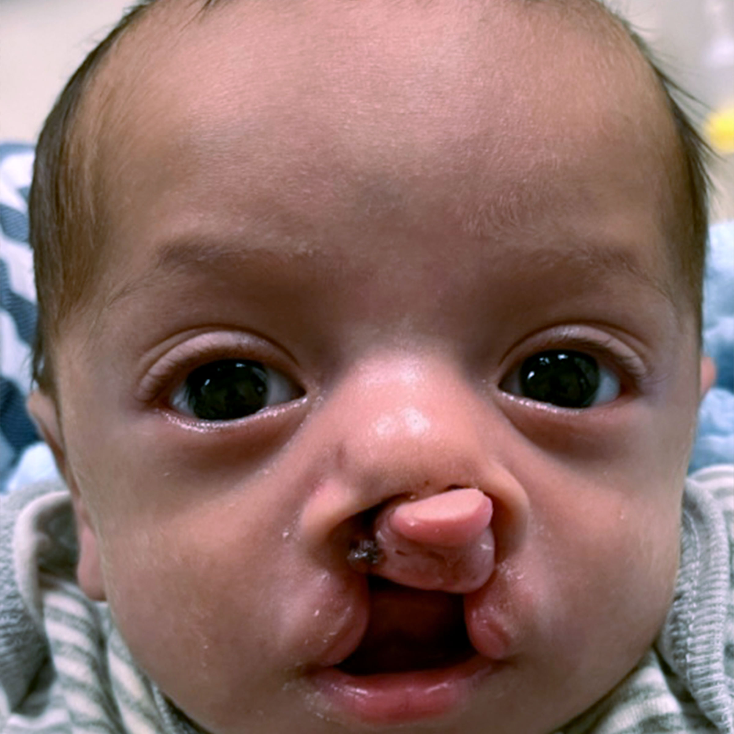 Cleft & Craniofacial Patient Transformation - Before