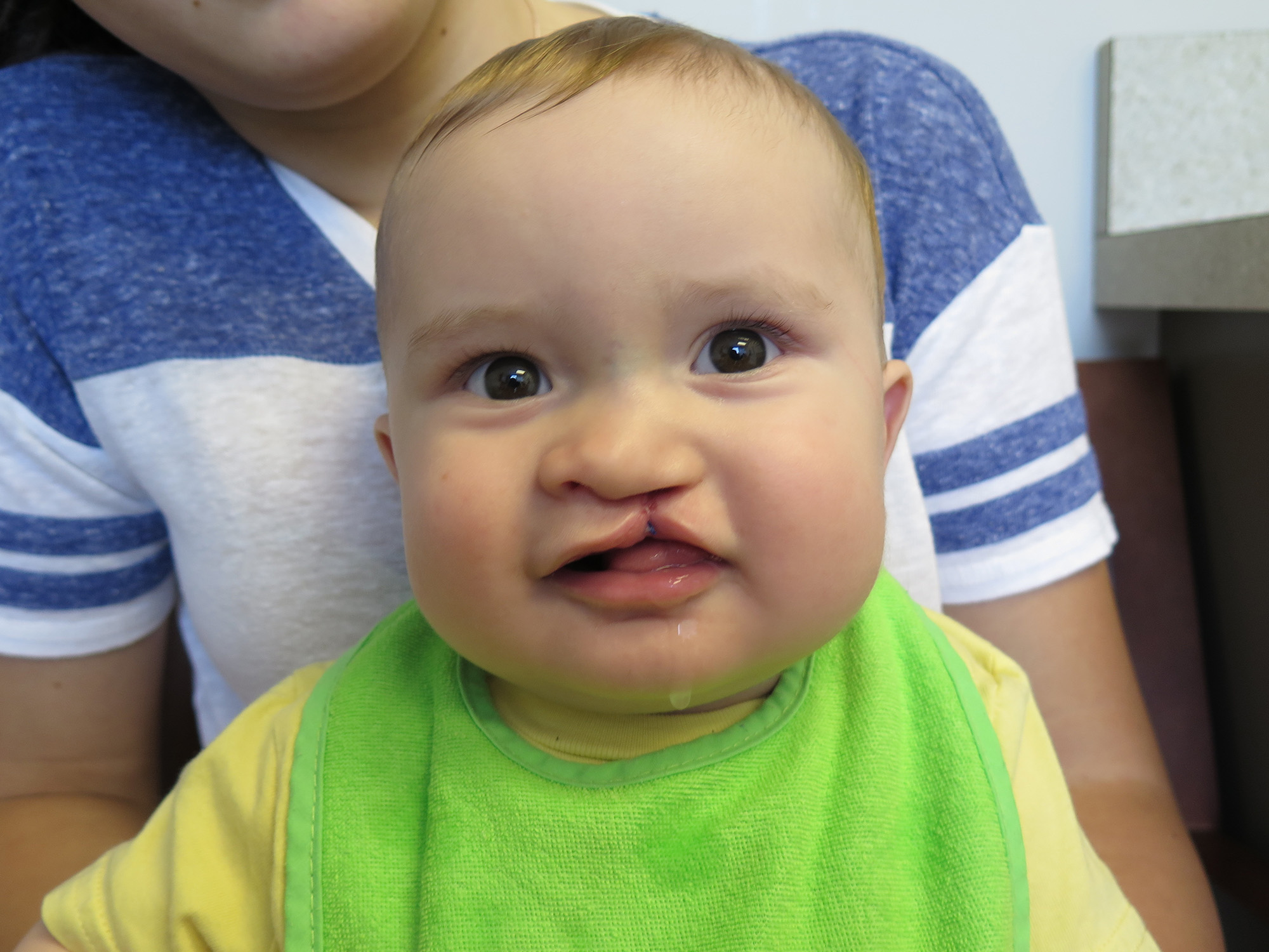 Cleft & Craniofacial Patient Transformation Journey