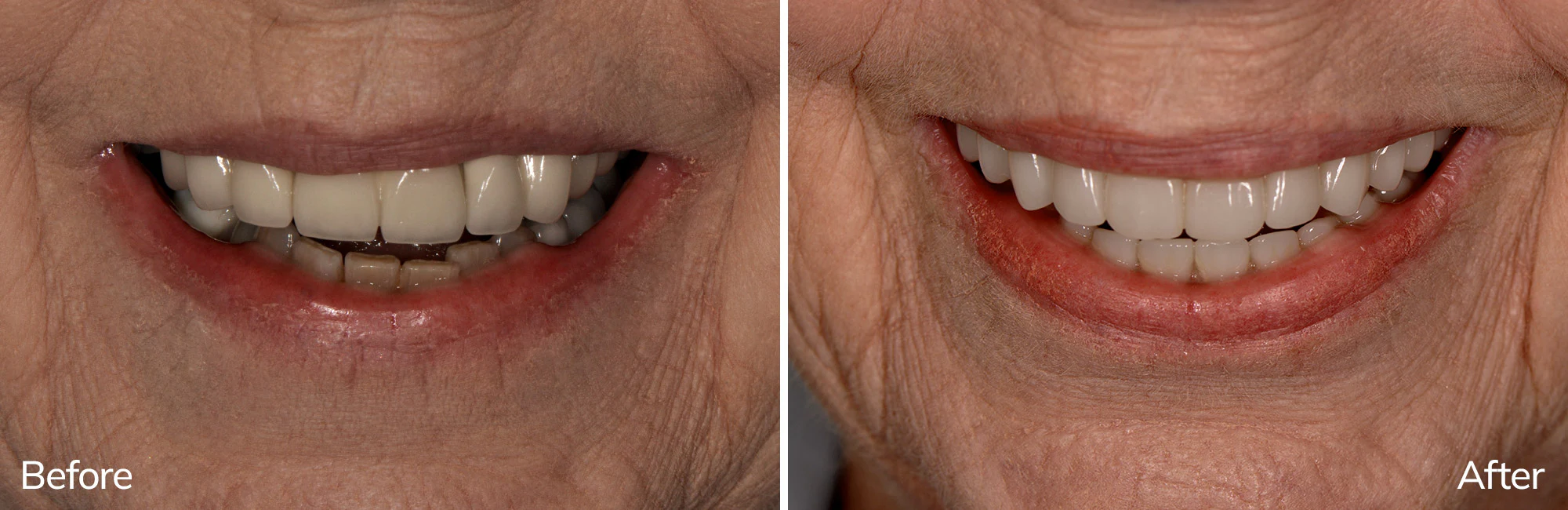 Marlene's before and after full arch dental implant transformation in Charlotte, NC