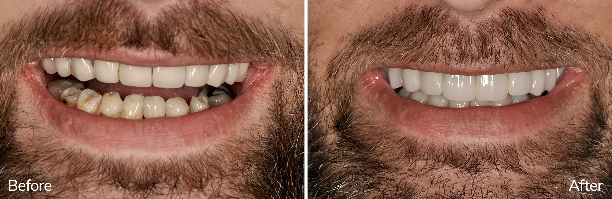 Richard's before and after full arch dental implants photos