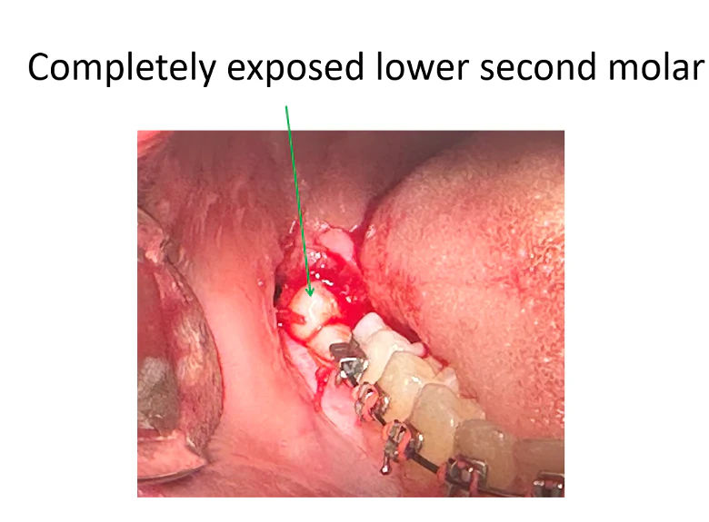 The lower second molar after surgical exposure, ready for the orthodontist to place a bracket and begin moving the tooth.