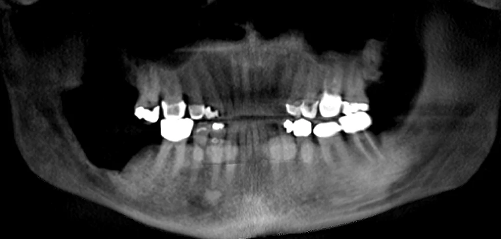 scan of patient with tumor removed
