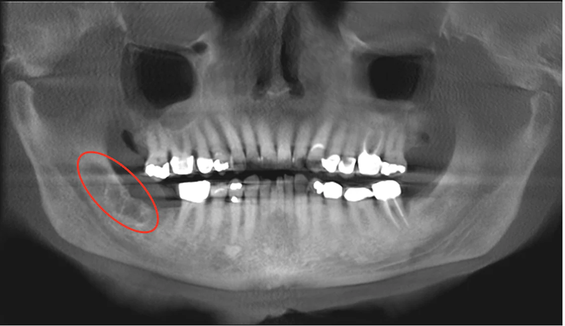 scan showing tumor in patients mouth
