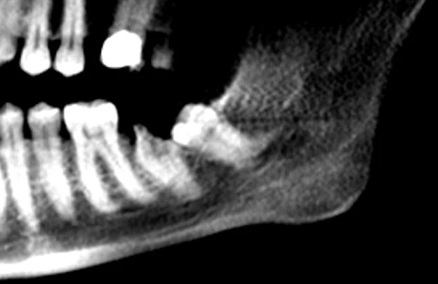 wisdom tooth xray