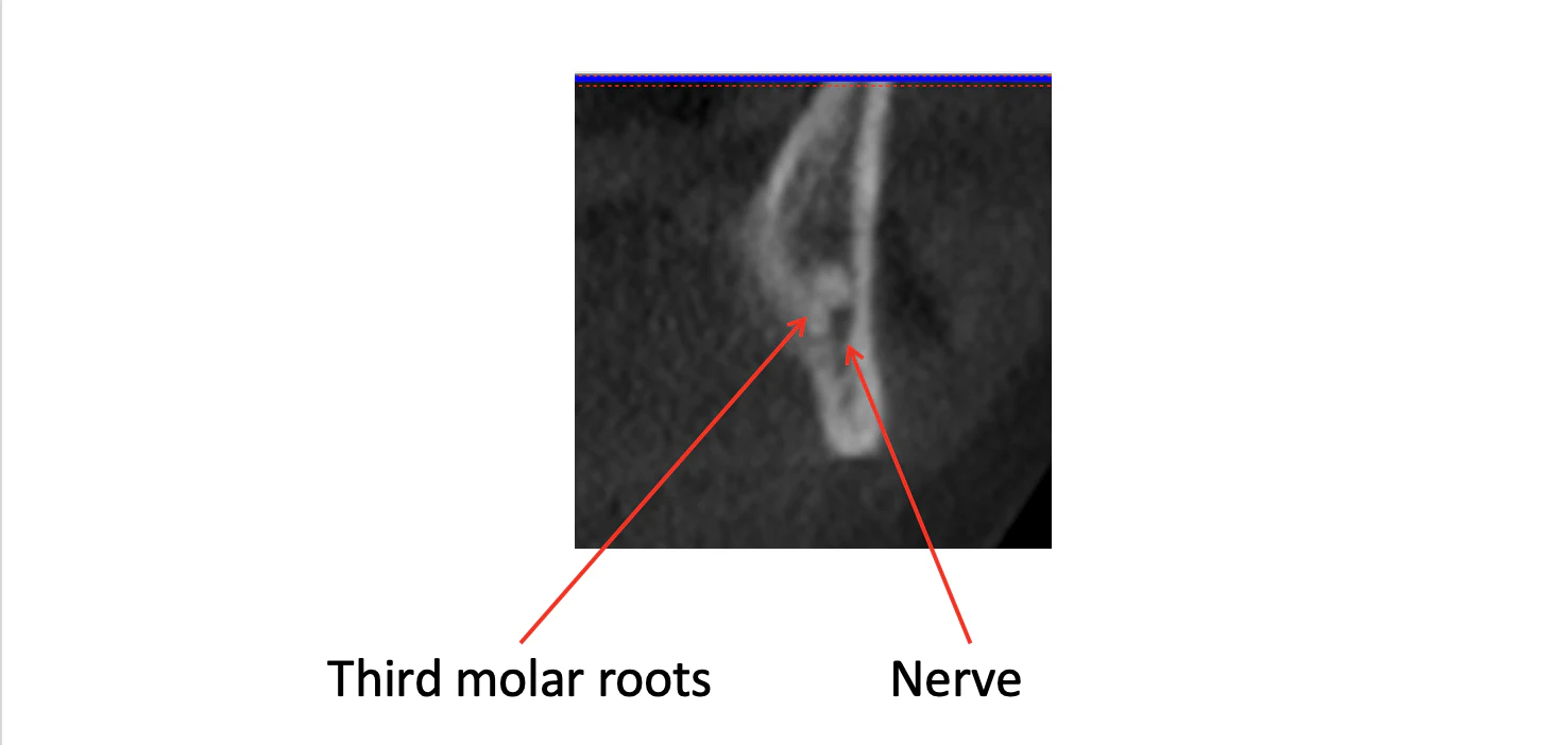 wisdom tooth scan show how close it is to the nerve.