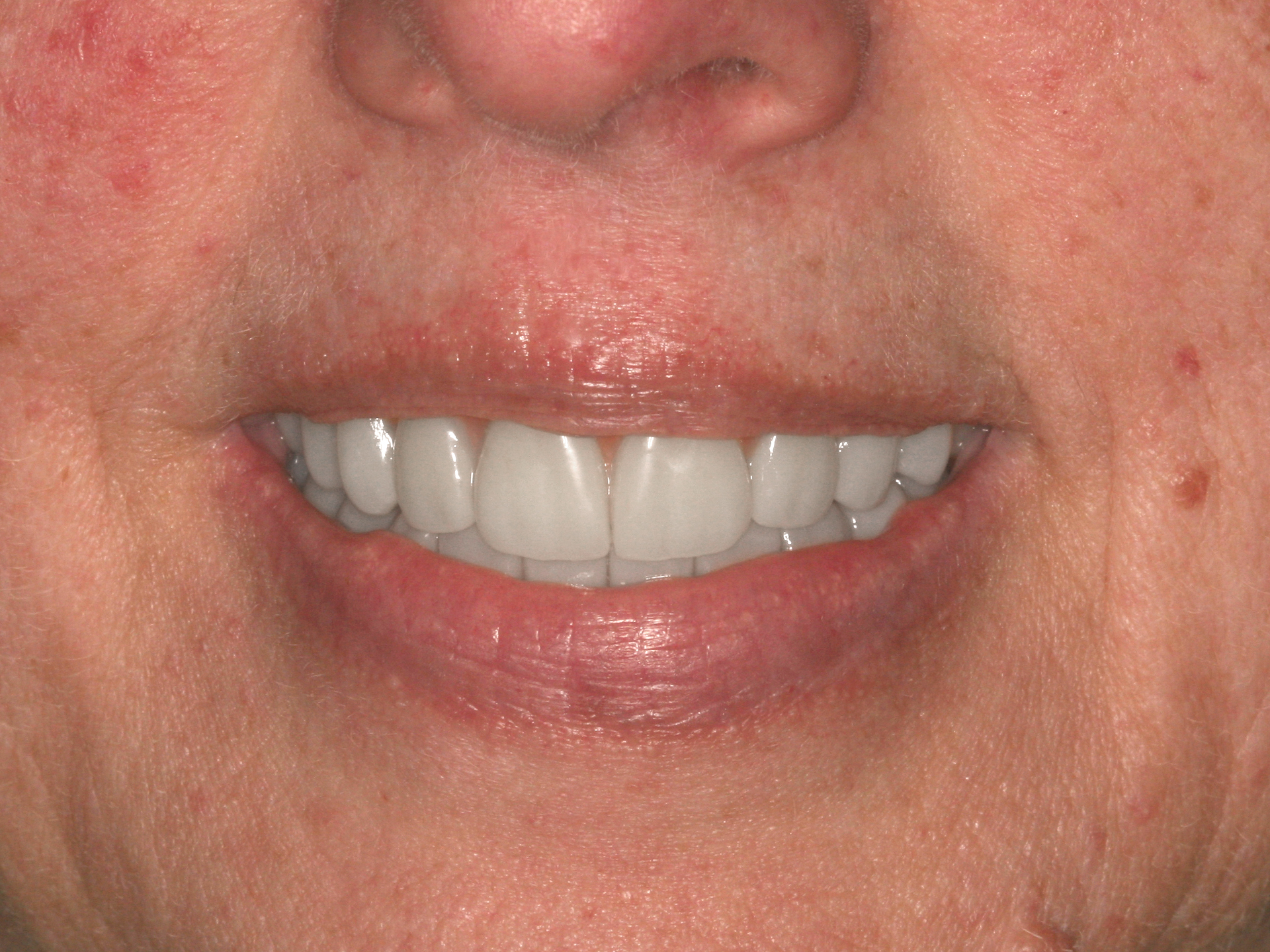 Dental Implant After: Dr. Hunter Dawson Envision Charlotte, NC