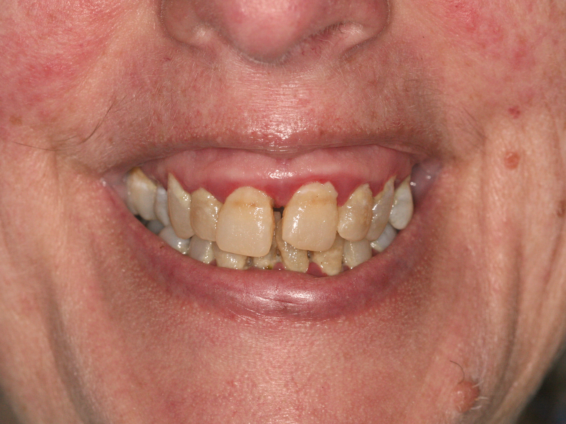 Dental Implant Before: Dr. Ryan Cook Envision Raleigh, NC