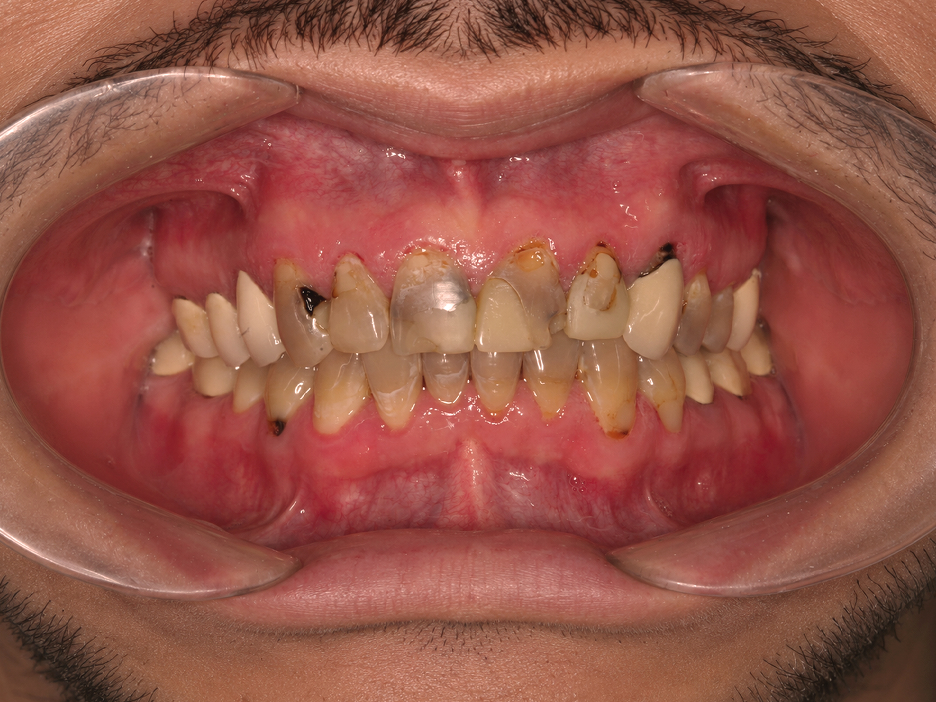 Dental Implant Before: Dr. Ryan Cook Envision Raleigh, NC
