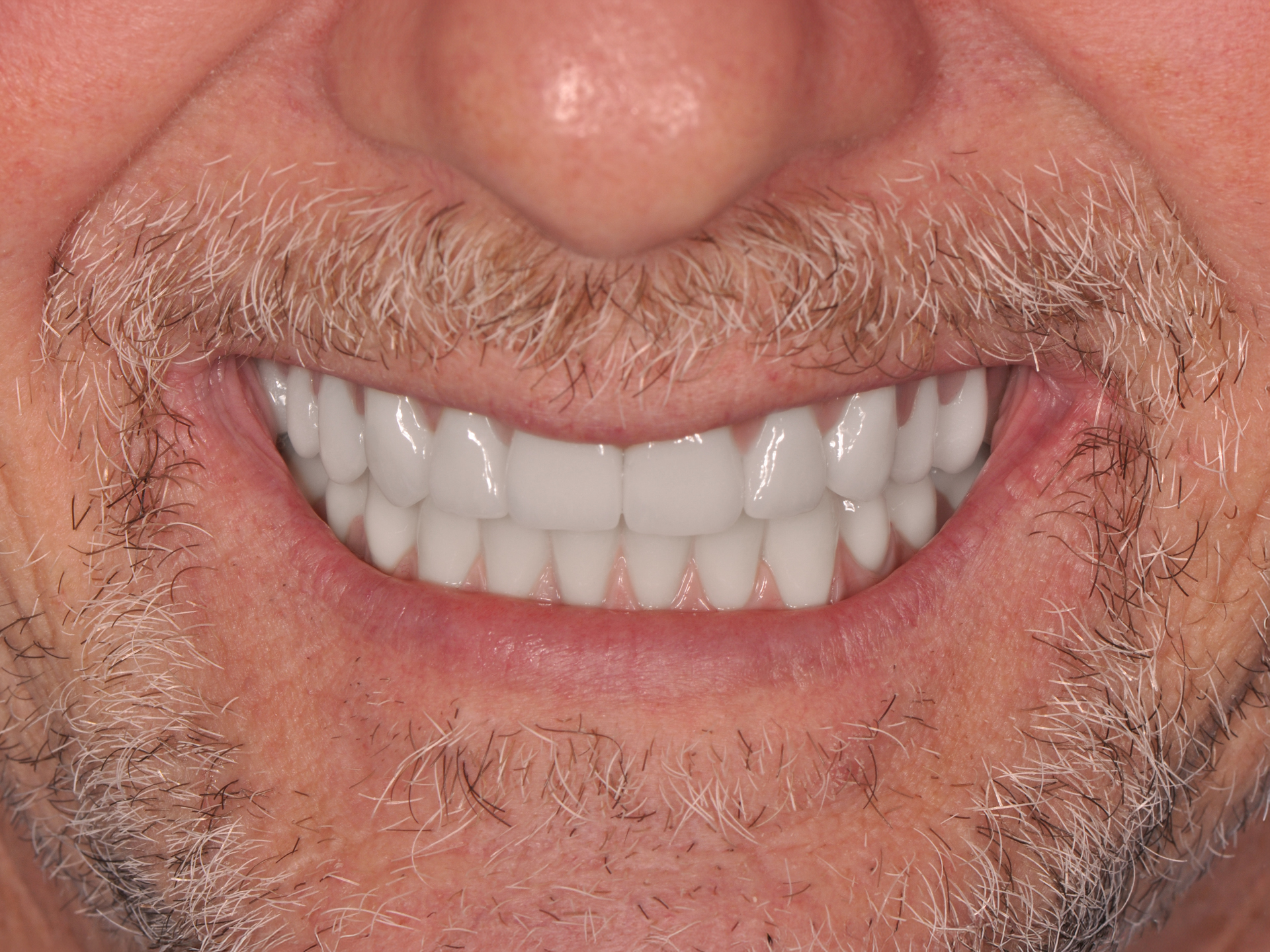 Dental Implant After: Dr. Hunter Dawson Envision Charlotte, NC
