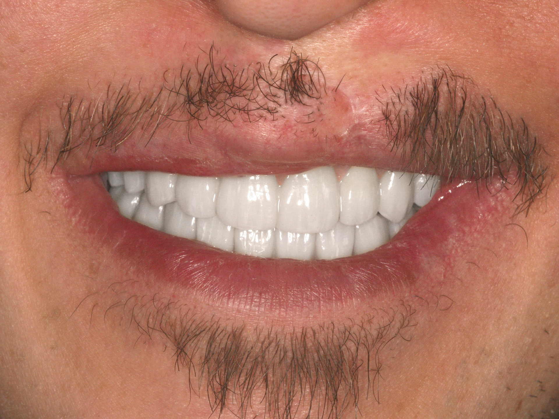 Dental Implant After: Dr. Hunter Dawson Envision Charlotte, NC