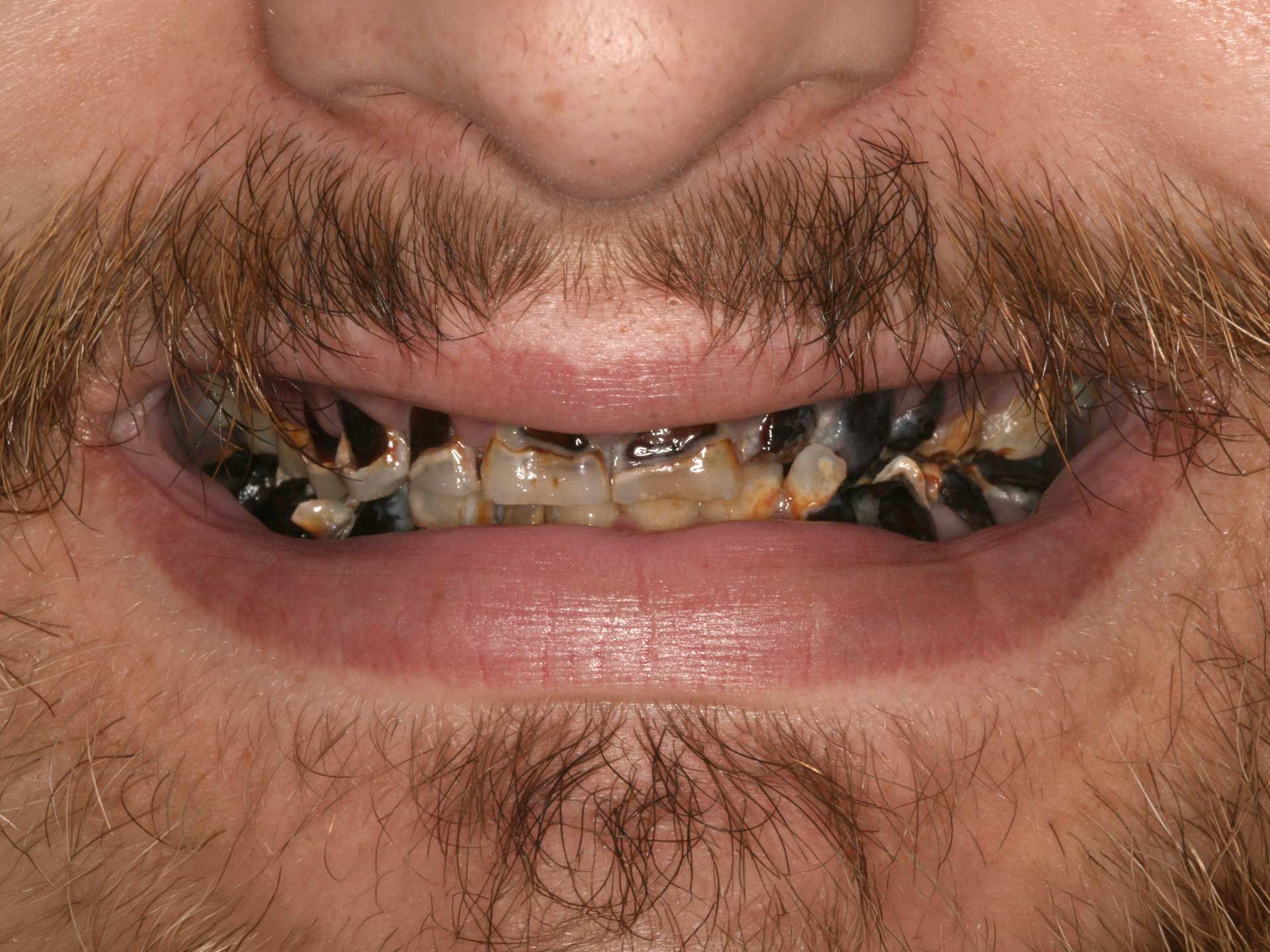 Dental Implant Before: Dr. Hunter Dawson Envision Charlotte, NC