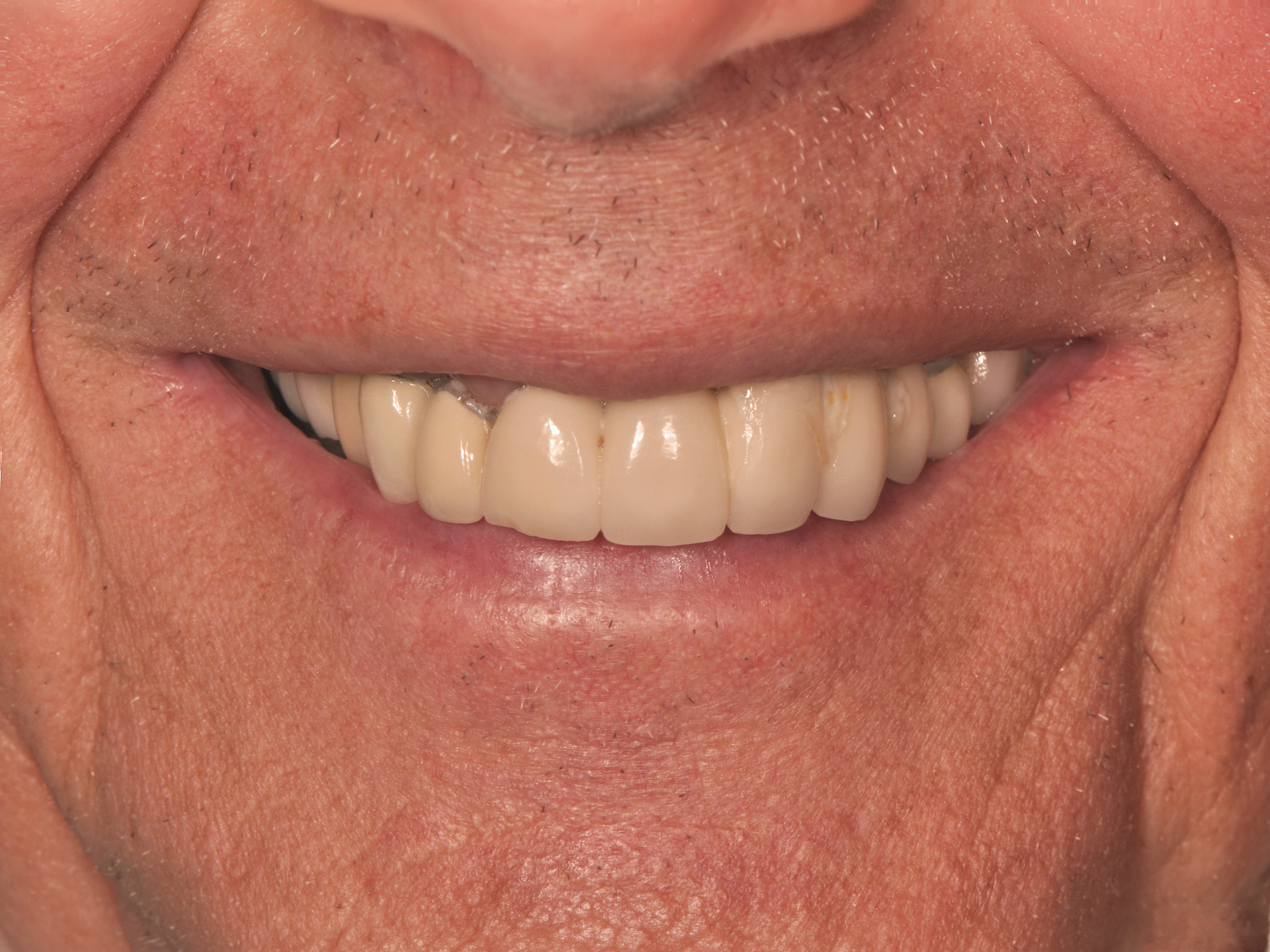 Dental Implant Before: Dr. Hunter Dawson Envision Charlotte, NC
