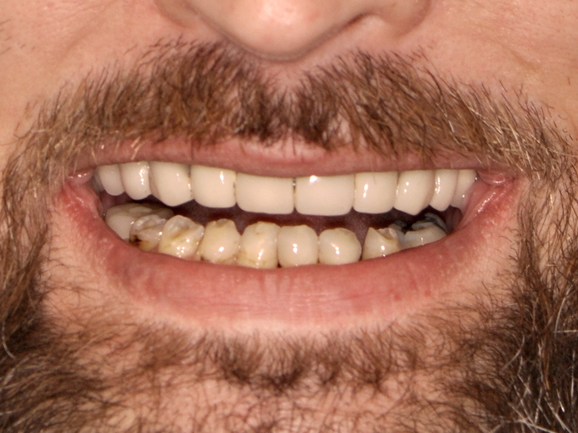 Dental Implant Before: Dr. Hunter Dawson Envision Charlotte, NC