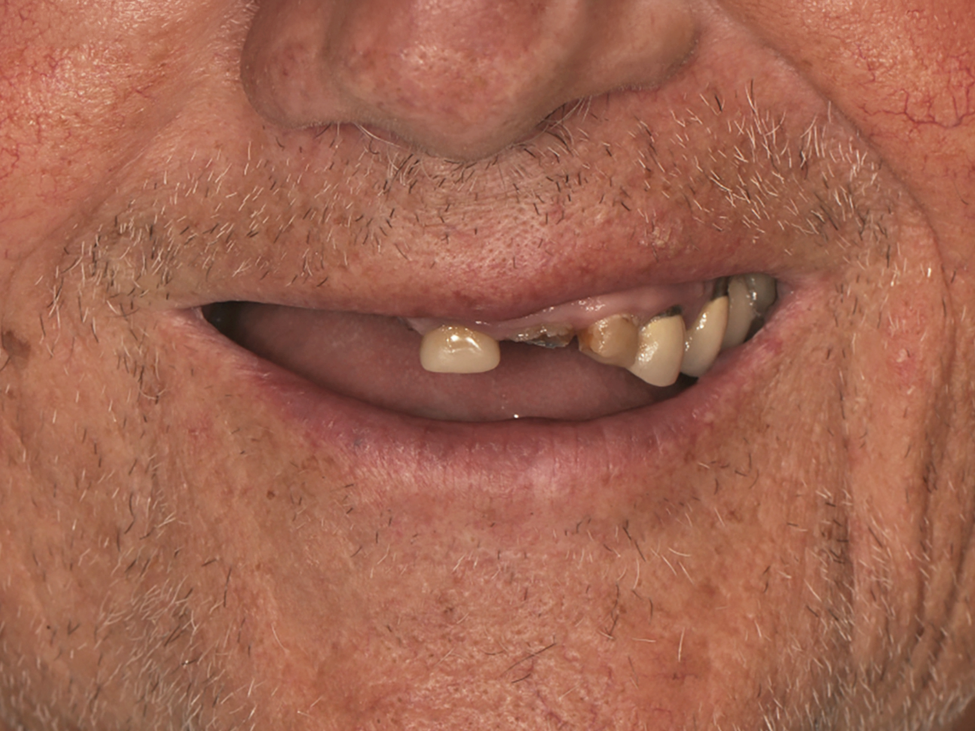 Dental Implant Before: Dr. Hunter Dawson Envision Charlotte, NC