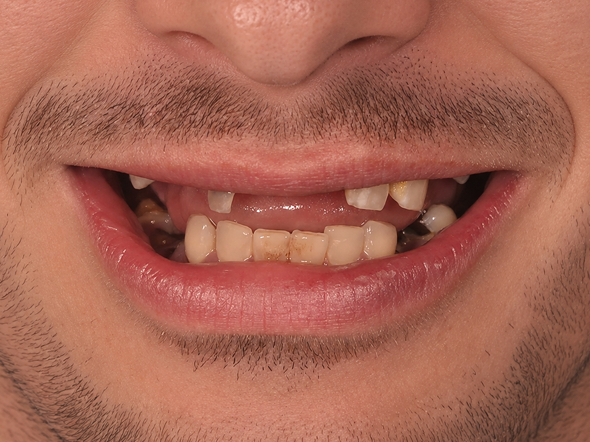 Dental Implant Before: Dr. Hunter Dawson Envision Charlotte, NC