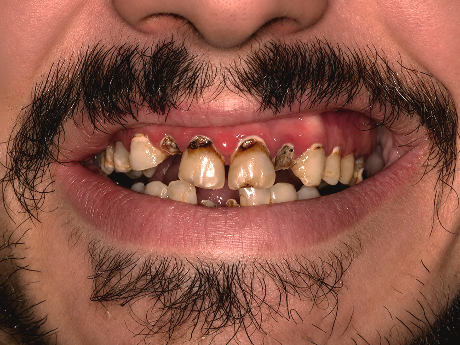 Dental Implant Before: Dr. Hunter Dawson Envision Charlotte, NC