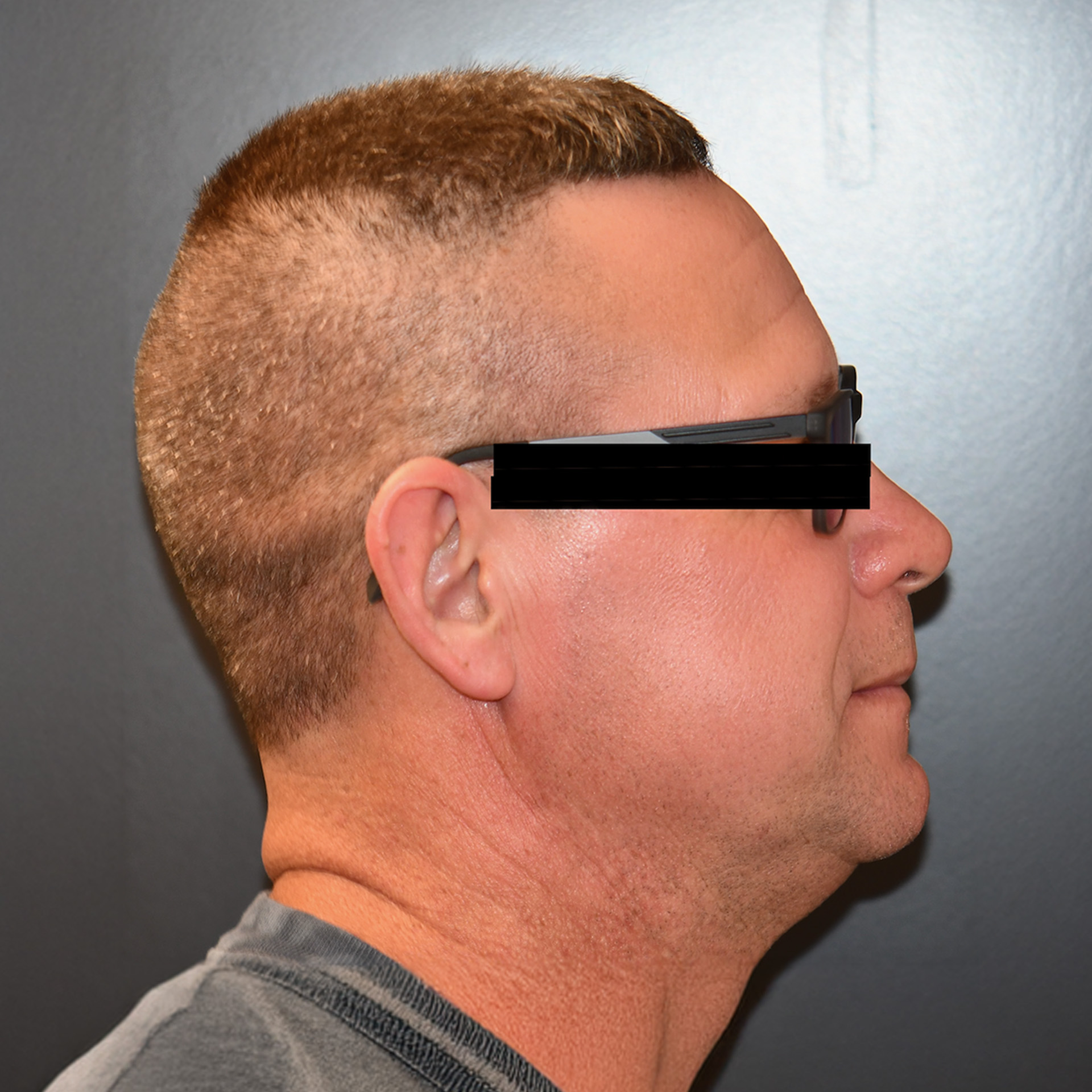 Jaw Surgery After: Dr Chad Dammling - CCOFS - Raleigh, NC
