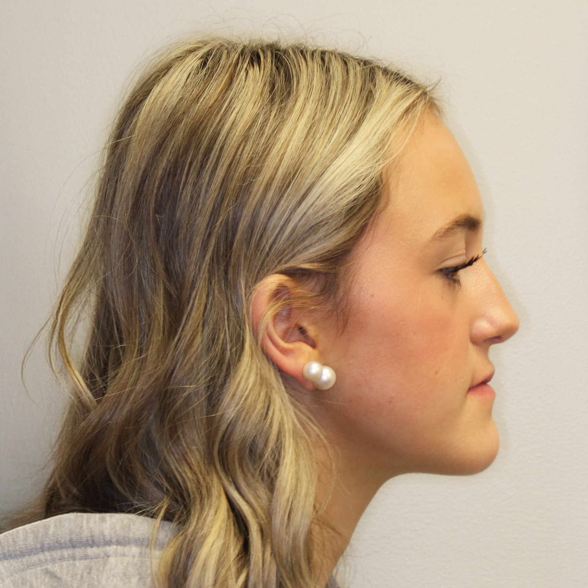 Jaw Surgery After: Dr. Peter Franco - CCOFS - Charlotte, NC