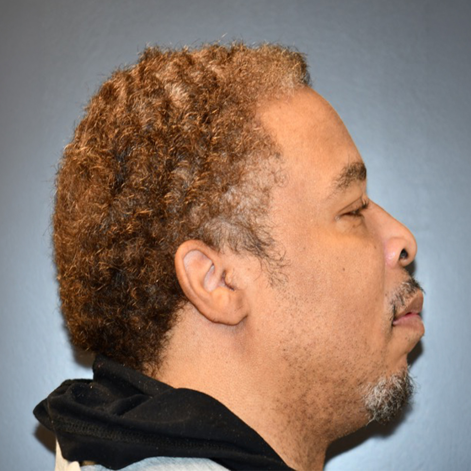Jaw Surgery Before: Dr Roger Moreira - CCOFS - Raleigh, NC