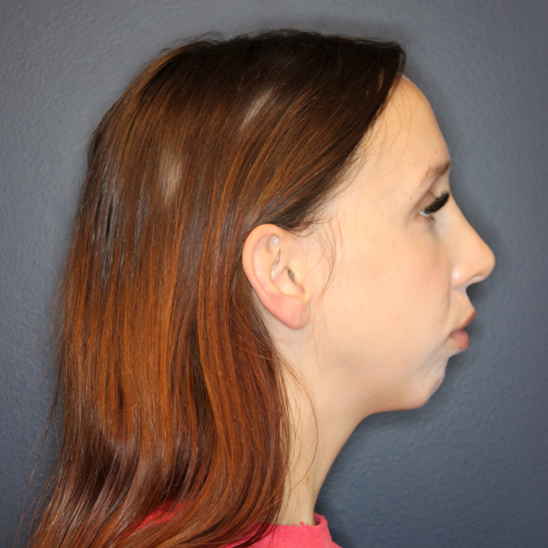 Jaw Surgery Before: Dr. Roger Moreira - CCOFS - Raleigh, NC