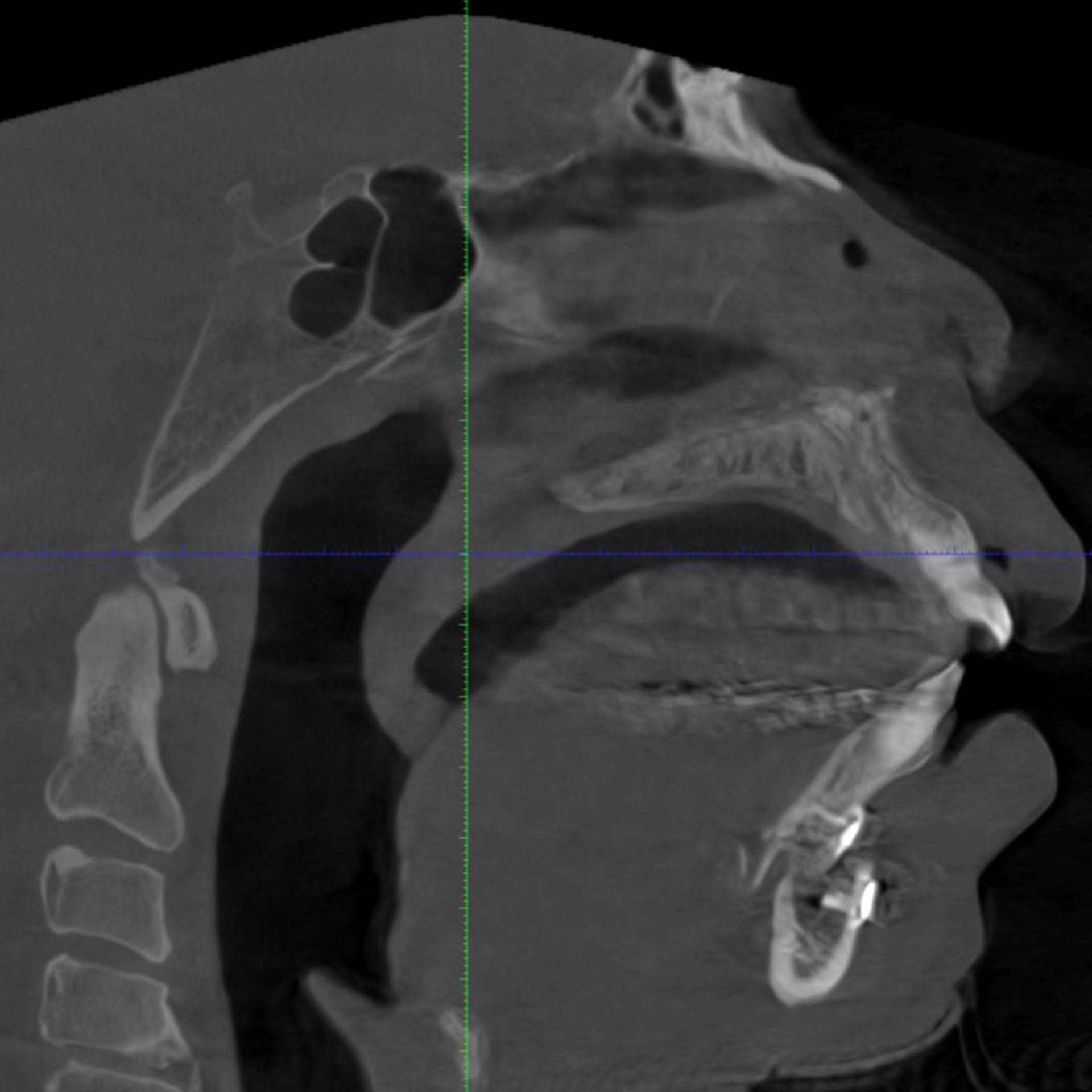 Jaw Surgery After: Dr Roger Moreira - CCOFS - Raleigh, NC