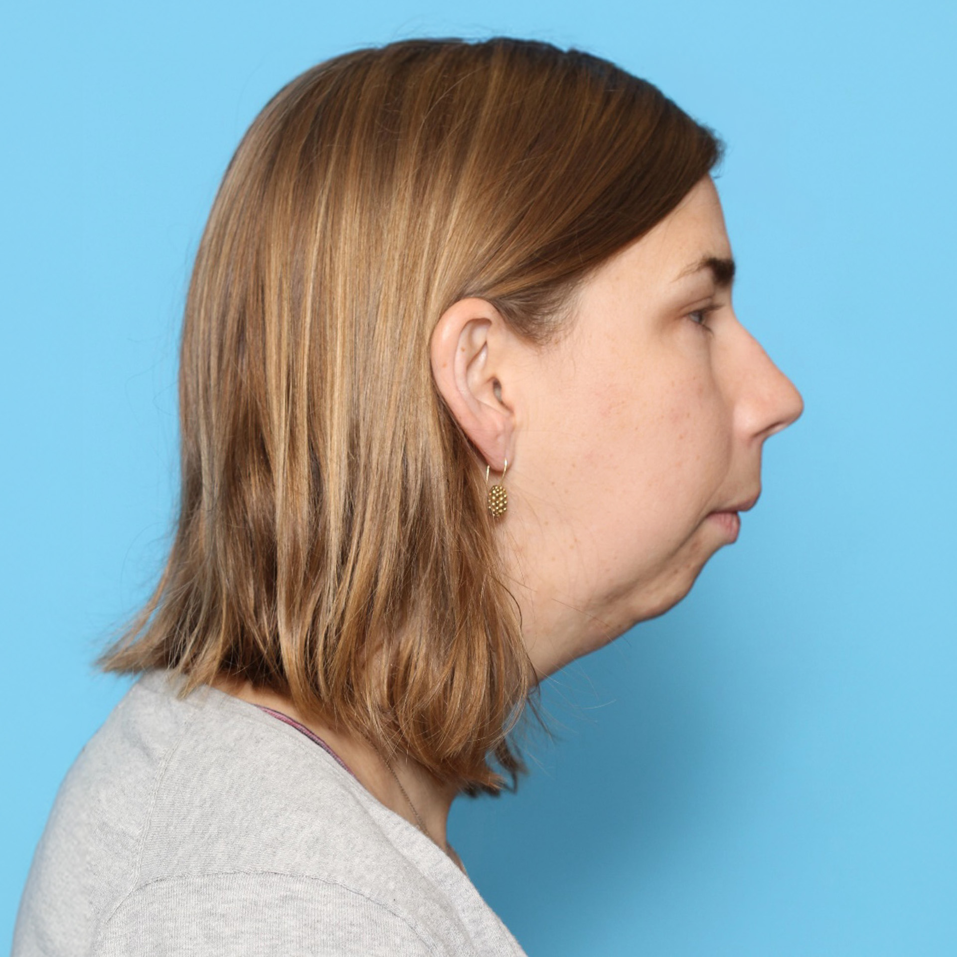 Jaw Surgery Before: Dr Roger Moreira - CCOFS - Raleigh, NC