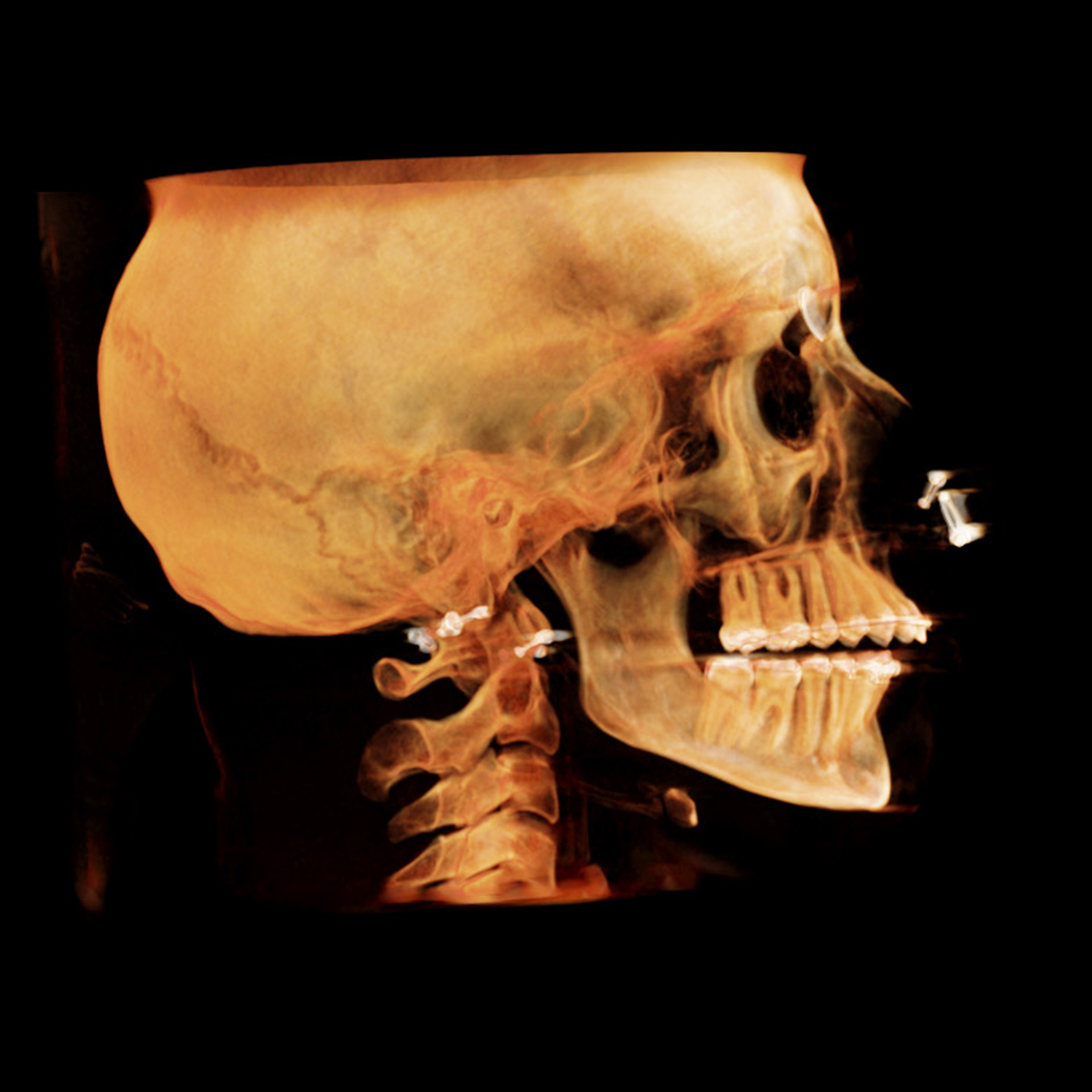 Jaw Surgery Before: Dr Matthew Pham - CCOFS - Columbia, SC