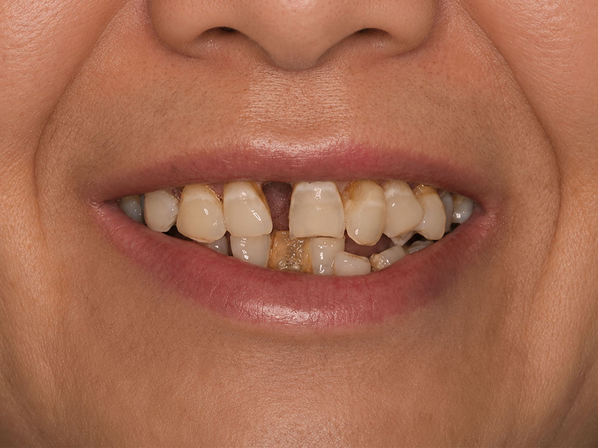 Dental Implant Before: Dr. Hunter Dawson Envision Charlotte, NC