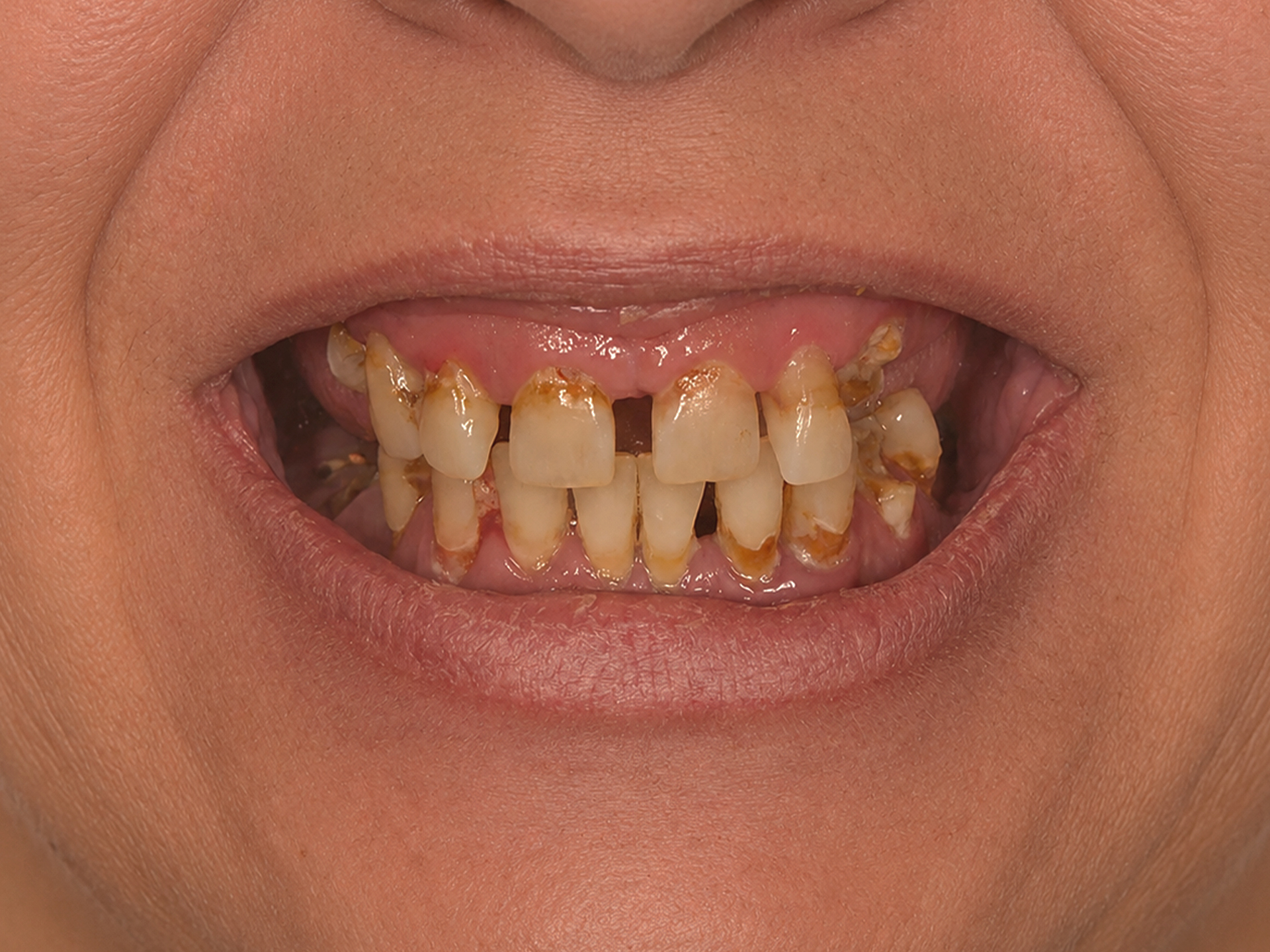 Dental Implant Before: Dr. Hunter Dawson Envision Charlotte, NC