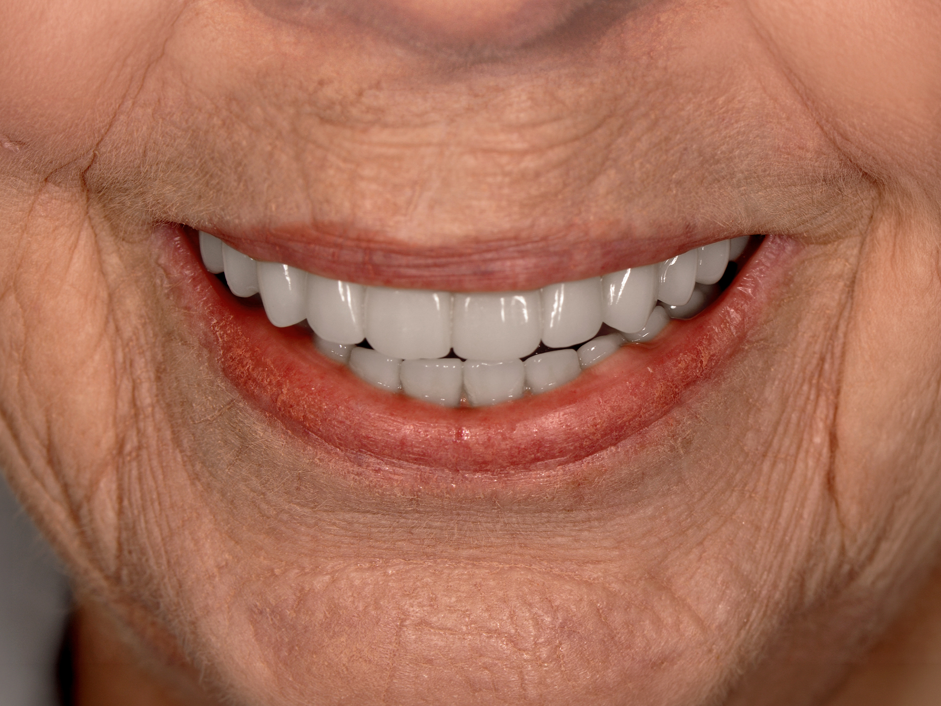 Dental Implant After: Envision Raleigh, NC