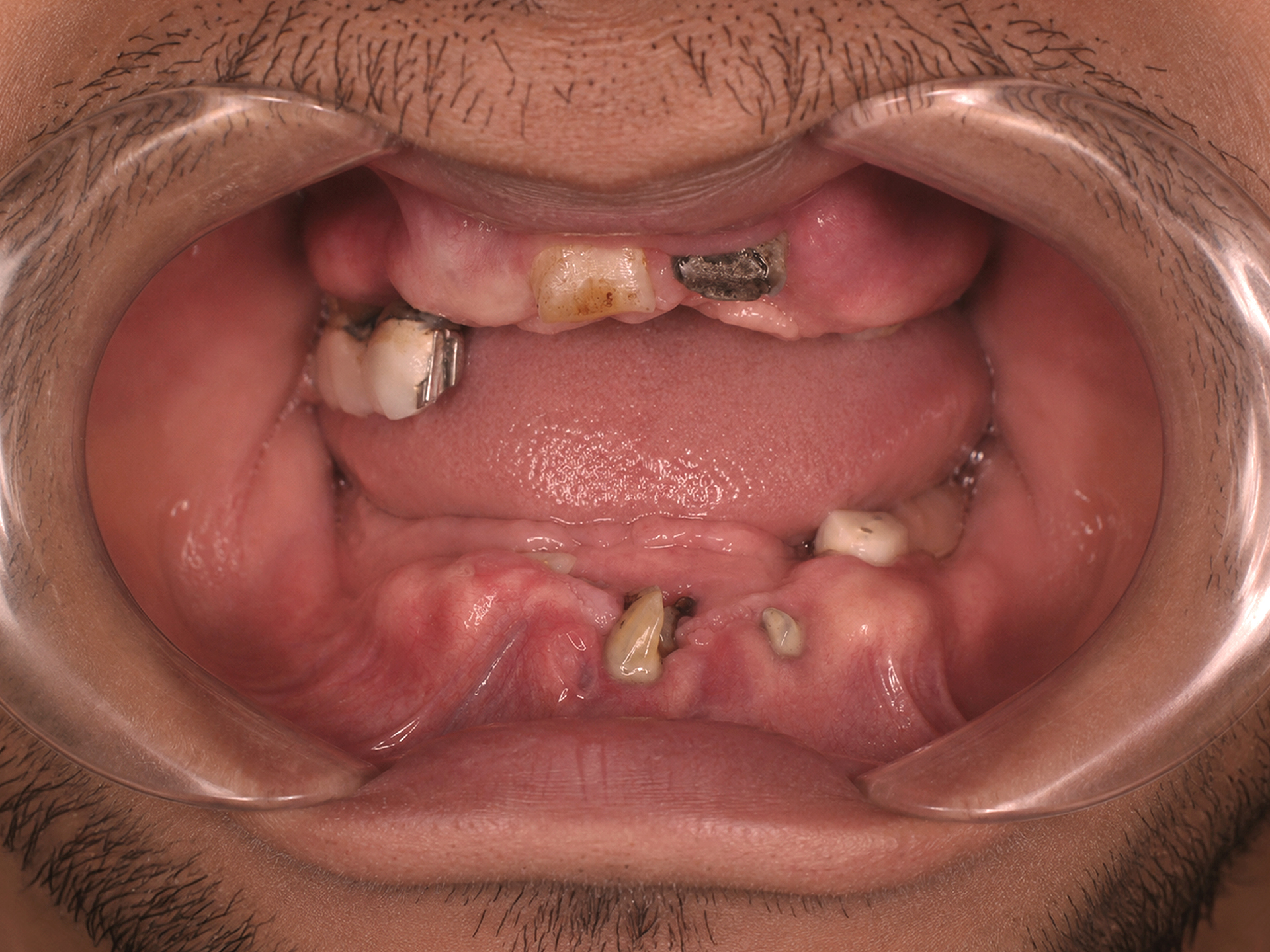 Dental Implant Before Envision