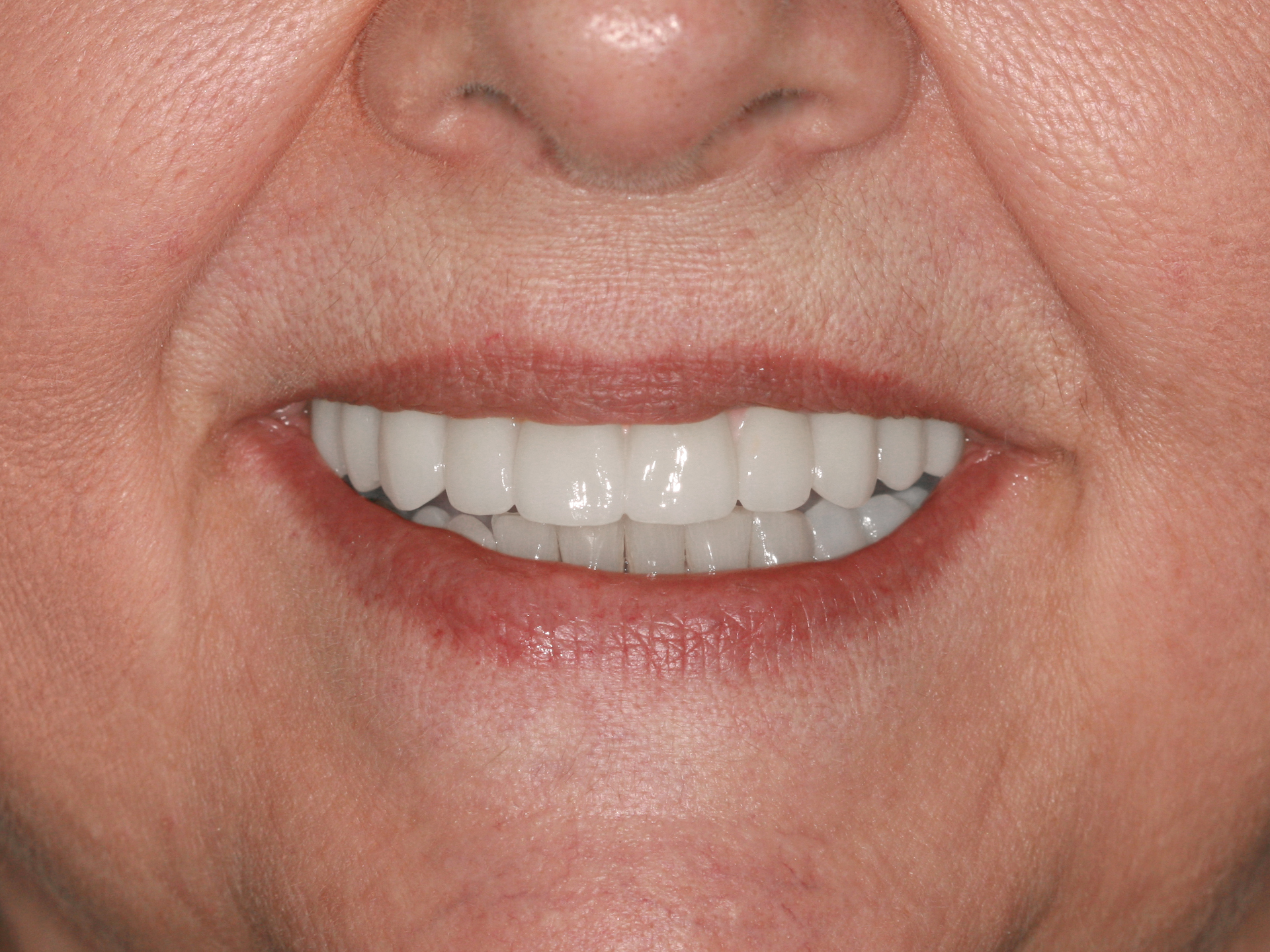 Dental Implant After: Dr. Craig Horton Envision Greenville, SC