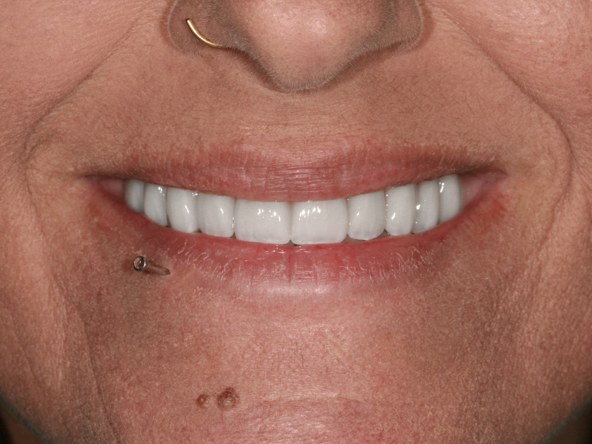 Dental Implant After: Dr. Craig Horton Envision Greenville, SC