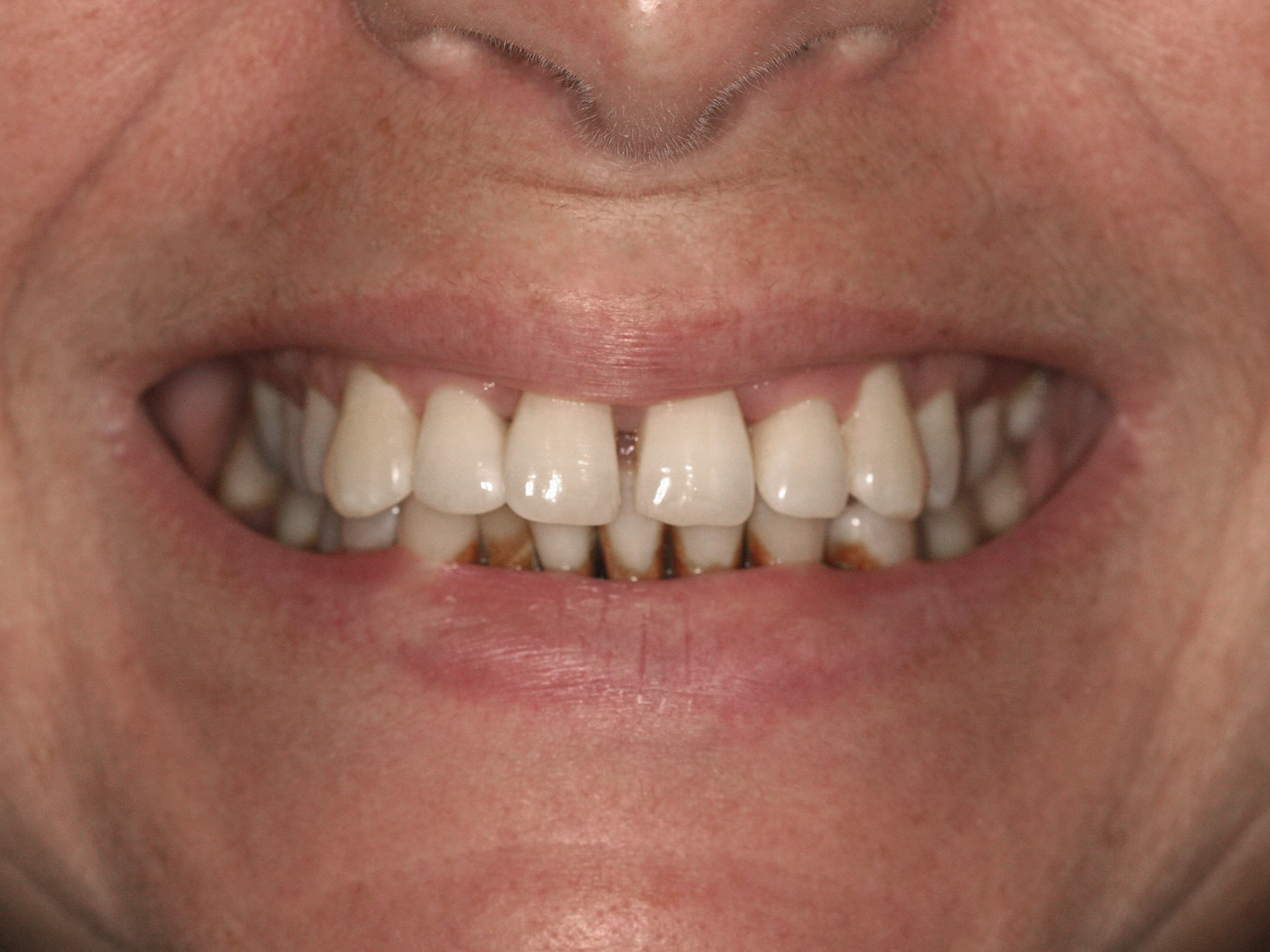 Dental Implant Before: Dr. Craig Horton Envision Greenville, SC
