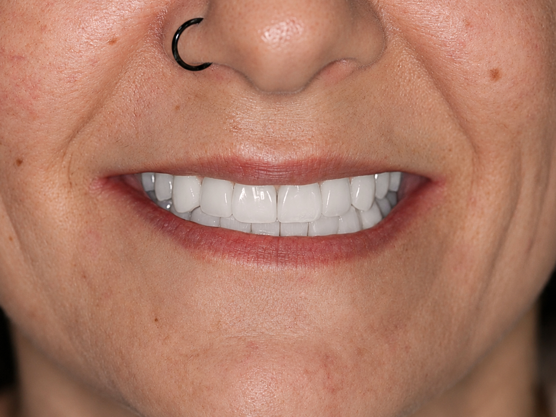 Dental Implant After: Dr. Craig Horton Envision Greenville, SC