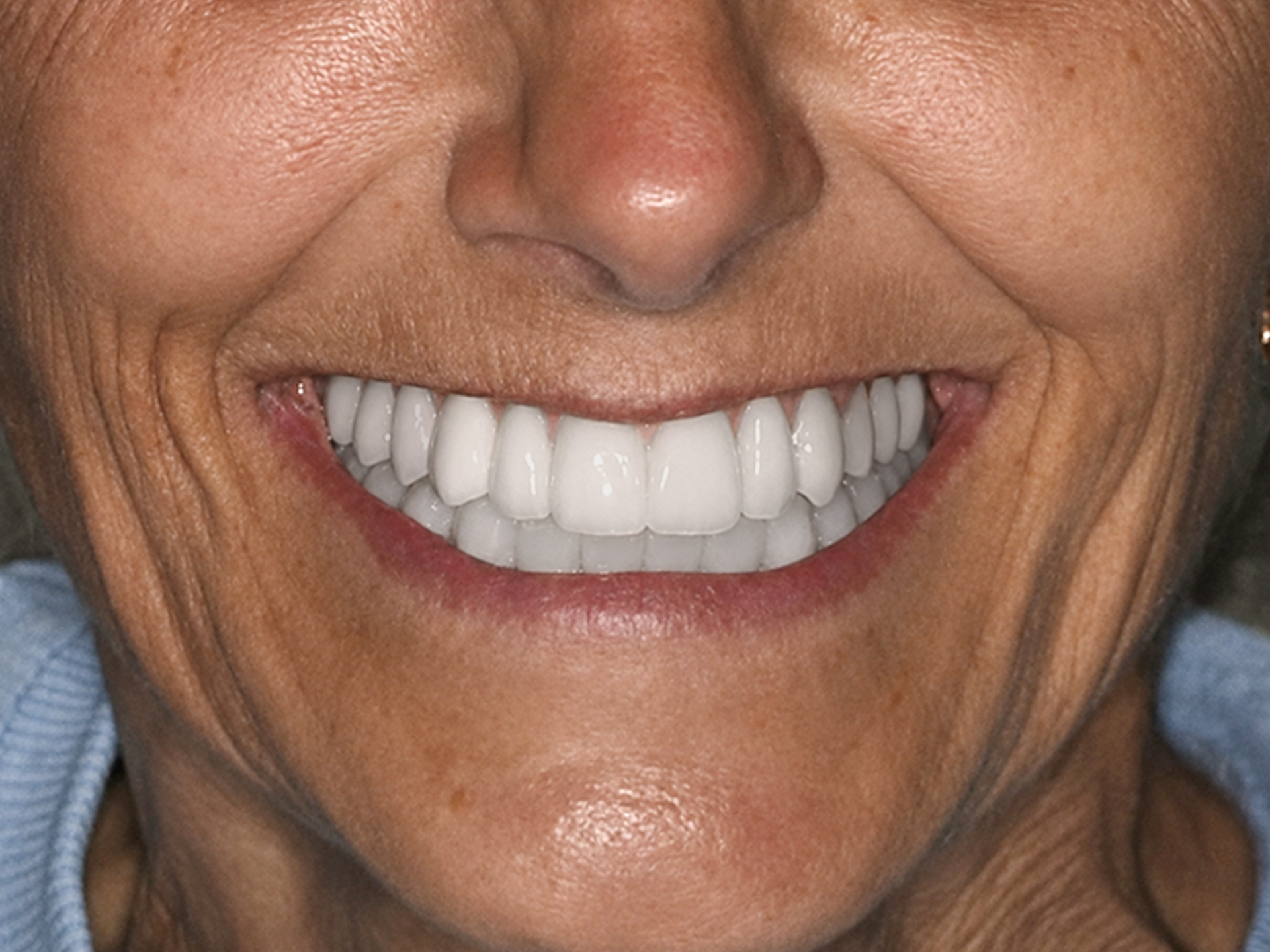 Dental Implant After: Dr. Craig Horton Envision Greenville, SC