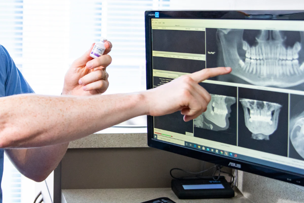 Exparel non-opioid local anesthetic used for post-surgical pain management after oral surgery.