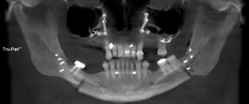 Dr. Abernathy's full arch patients before scan